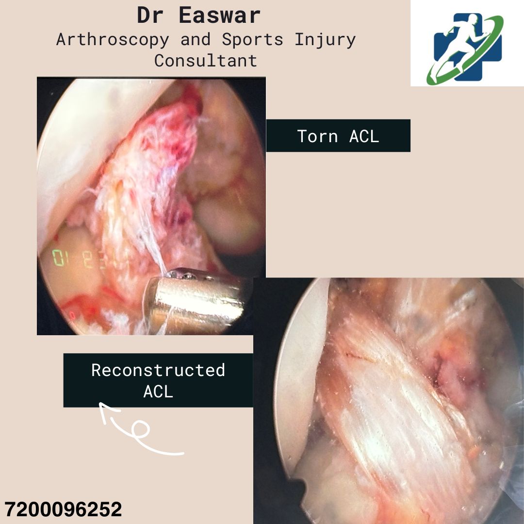 ACL RECONSTRUCTION